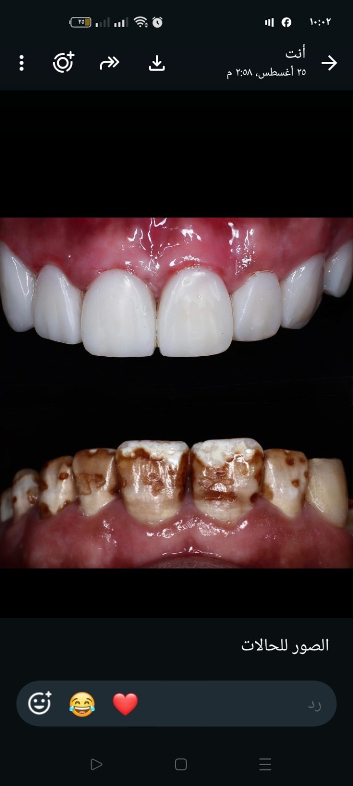 Patient dental smile case 5 at Care Plus Dental Clinic in Hurghada