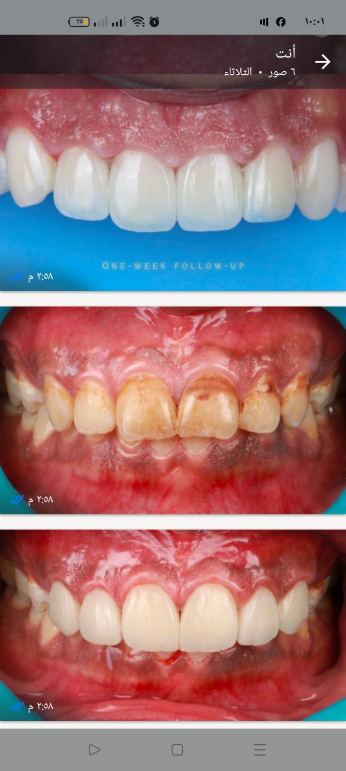 Patient dental smile case 6 at Care Plus Dental Clinic in Hurghada